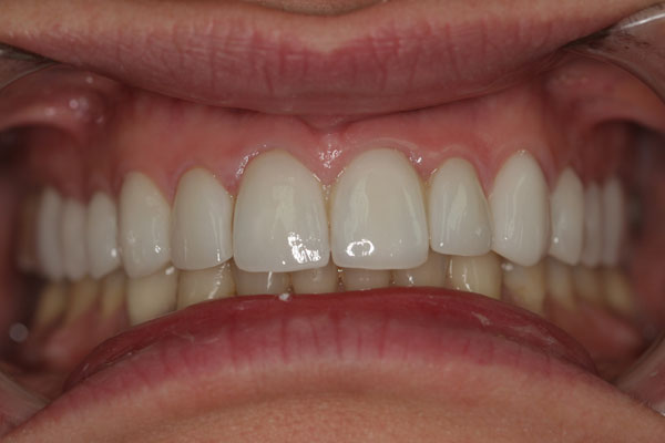 11-after-porcelain-veneers