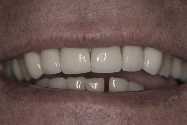 after-crowns-2