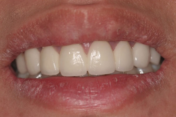 after-crowns