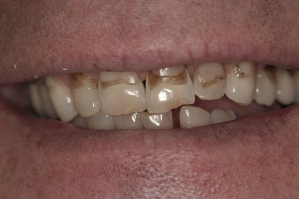 before-crowns-2