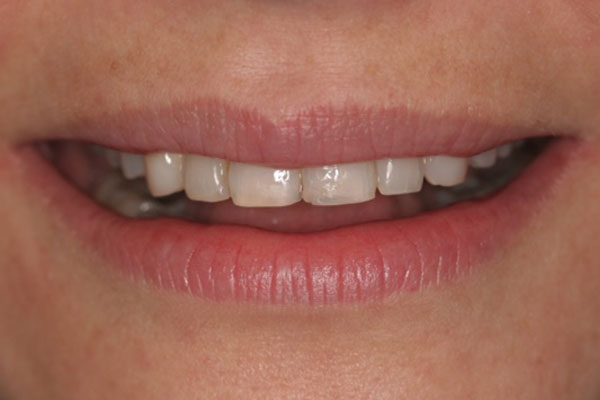 before-veneers